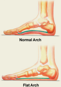 Normal Arch - Flat Arch