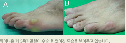 튀어나온 제 5족지관절이 수술 후 없어진 모습을 보여주고 있습니다.