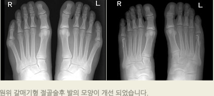 원위 갈매기형 절골술후 발의 모양이 개선 되었습니다. 