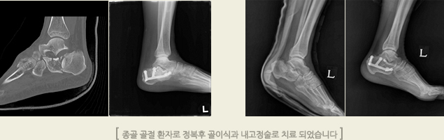 종골 골절 환자로 정복후 골이식과 내고정술로 치료 되었습니다